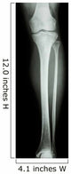 Film X-Ray Normal Humans Leg 