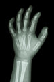X-Ray Infants Hand 