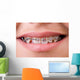 Mouth with brackets braces in medical concept Wall Mural