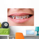 Mouth with brackets braces in medical concept Wall Mural