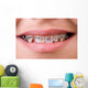 Mouth with brackets braces in medical concept Wall Mural