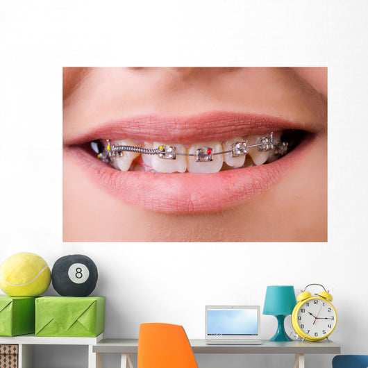 Mouth with brackets braces in medical concept Wall Mural