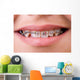 Mouth with brackets braces in medical concept Wall Mural