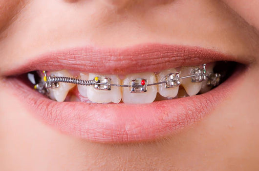 Mouth with brackets braces in medical concept Wall Mural
