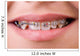 Mouth with brackets braces in medical concept Wall Mural