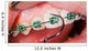 Teeth with braces Wall Mural