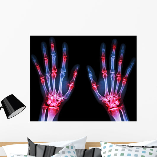 Arthritis Multiple Joint Hands Wall Decal