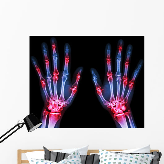 Arthritis Multiple Joint Hands Wall Decal