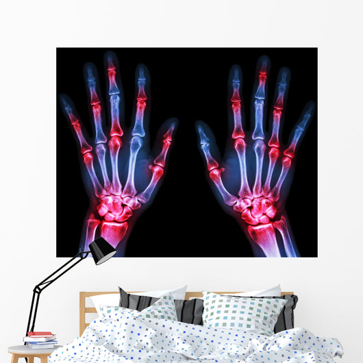 Arthritis Multiple Joint Hands Wall Decal