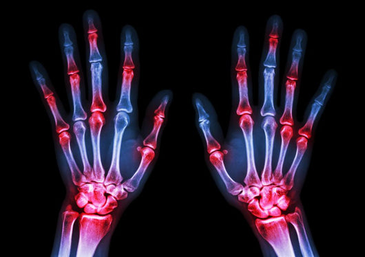 Arthritis Multiple Joint Hands Wall Decal