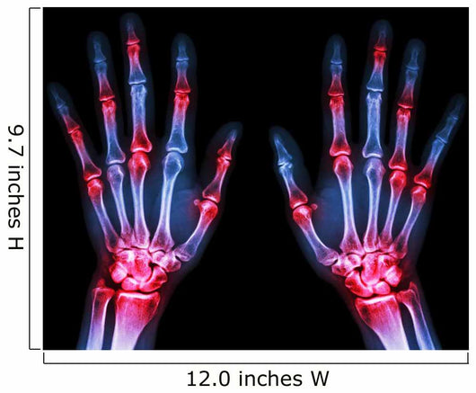 Arthritis Multiple Joint Hands Wall Decal