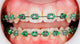Braces On Teeth Wall Decal