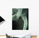 femur fracture Wall Mural