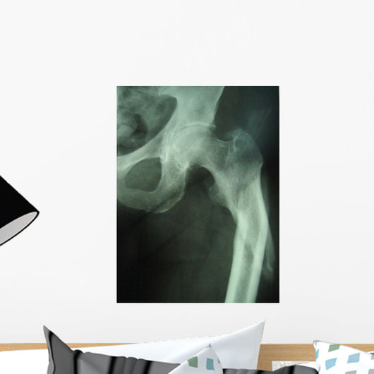 femur fracture Wall Mural