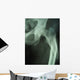 femur fracture Wall Mural