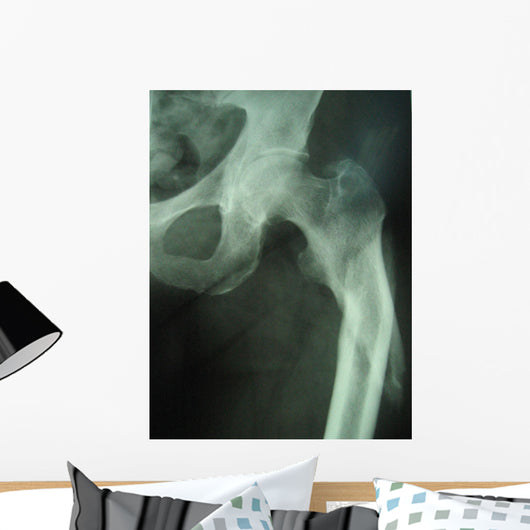 femur fracture Wall Mural