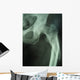 femur fracture Wall Mural