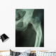 femur fracture Wall Mural