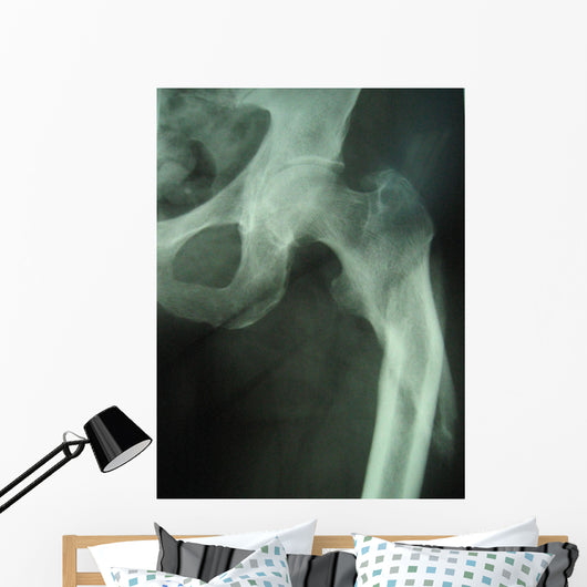 femur fracture Wall Mural