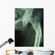 femur fracture Wall Mural