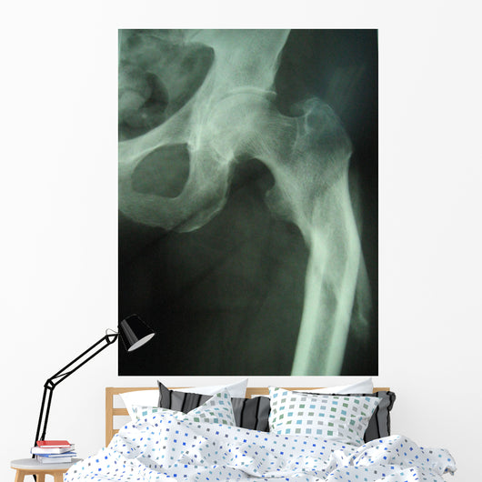 femur fracture Wall Mural