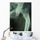 femur fracture Wall Mural