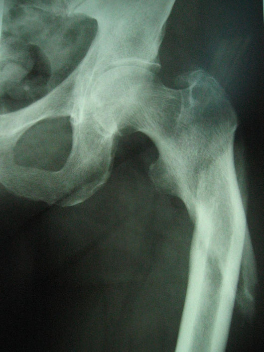 Femur Fracture Wall Decal