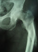 Femur Fracture Wall Decal