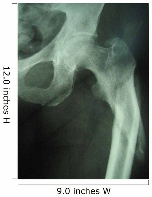 femur fracture Wall Mural
