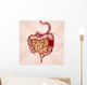 colon cancer Wall Mural