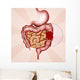 colon cancer Wall Mural
