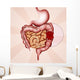 colon cancer Wall Mural