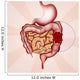 colon cancer Wall Mural