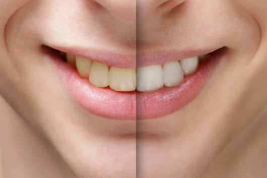 Young Man Smile Before And After Teeth Whitening Wall Decal