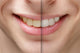 Young Man Smile Before And After Teeth Whitening Wall Decal
