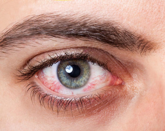Irritated red bloodshot eye Wall Mural