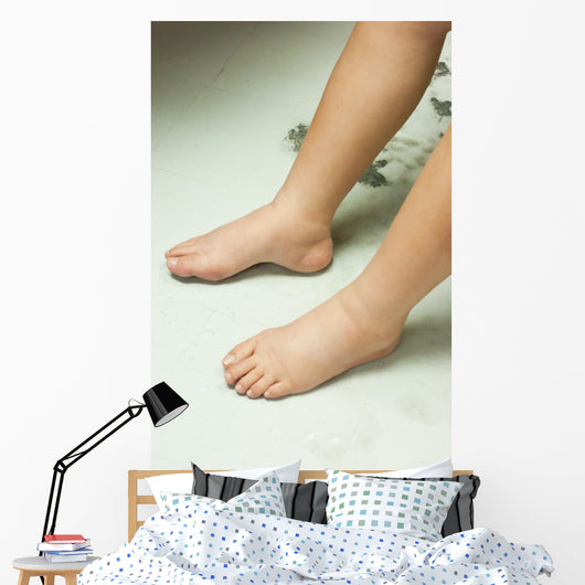 Gross edema of leg and foot Wall Mural