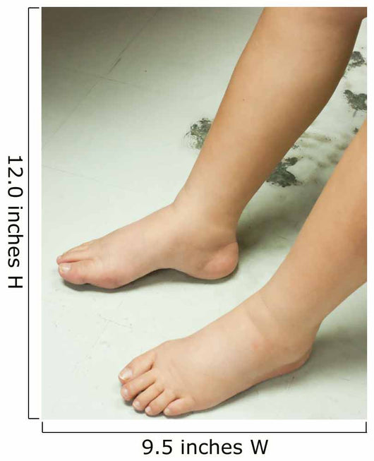 Gross edema of leg and foot Wall Mural