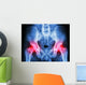 human's pelvis and arthritis at both hip joint (Gout,Rheumatoid) Wall Mural