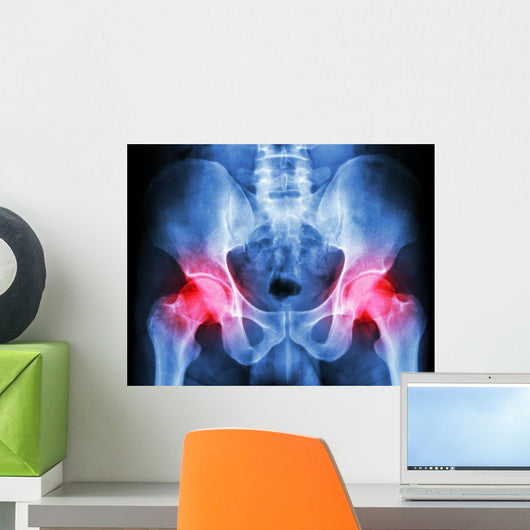 human's pelvis and arthritis at both hip joint (Gout,Rheumatoid) Wall Mural