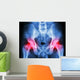 human's pelvis and arthritis at both hip joint (Gout,Rheumatoid) Wall Mural