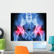 human's pelvis and arthritis at both hip joint (Gout,Rheumatoid) Wall Mural
