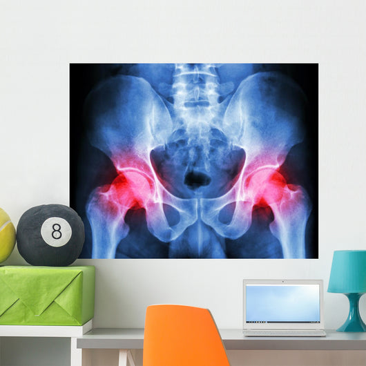 human's pelvis and arthritis at both hip joint (Gout,Rheumatoid) Wall Mural