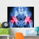 human's pelvis and arthritis at both hip joint (Gout,Rheumatoid) Wall Mural