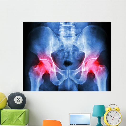 human's pelvis and arthritis at both hip joint (Gout,Rheumatoid) Wall Mural