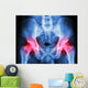 human's pelvis and arthritis at both hip joint (Gout,Rheumatoid) Wall Mural
