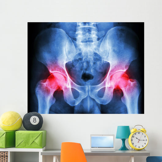 human's pelvis and arthritis at both hip joint (Gout,Rheumatoid) Wall Mural
