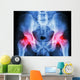 human's pelvis and arthritis at both hip joint (Gout,Rheumatoid) Wall Mural