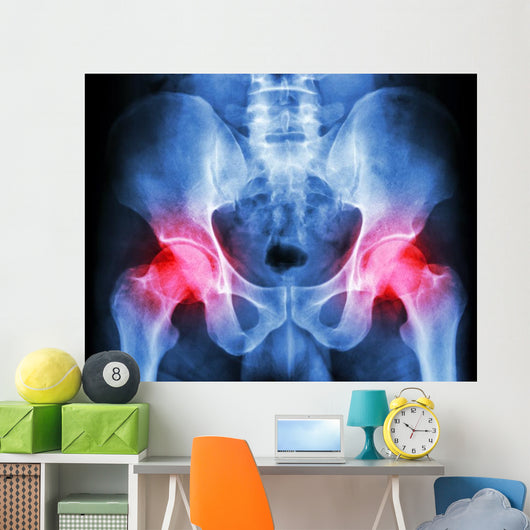 human's pelvis and arthritis at both hip joint (Gout,Rheumatoid) Wall Mural
