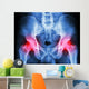 human's pelvis and arthritis at both hip joint (Gout,Rheumatoid) Wall Mural